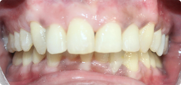 Close-up of straightened teeth