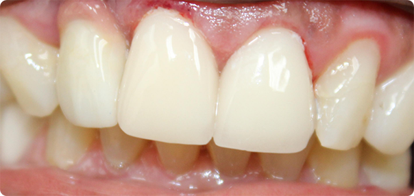 Close-up of smile with healthier gums