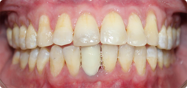 Close-up of properly aligned teeth