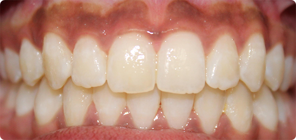 Close-up of smile after treatment