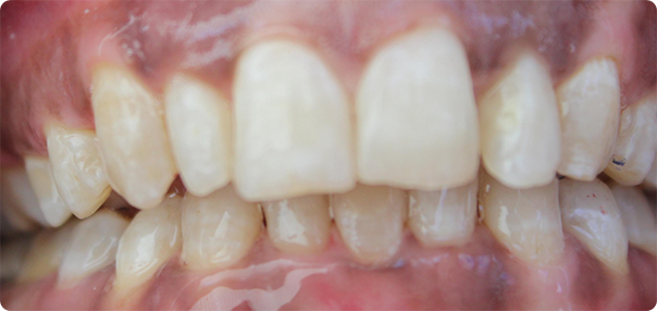 Close-up of more properly aligned teeth