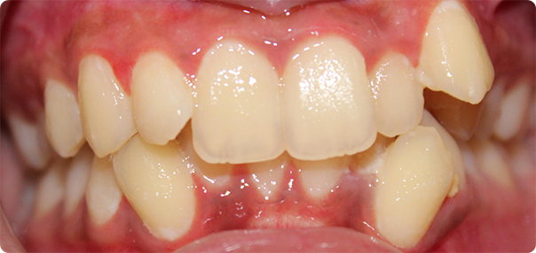 Close-up of misaligned teeth