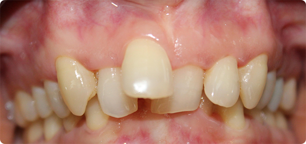 Close-up of badly misaligned teeth