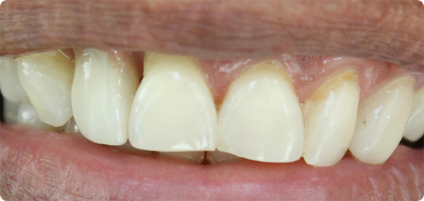 Close-up of smile with gum recession