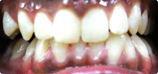 Close-up of smile with inflamed gums