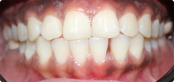 Close-up of smile with gap between two teeth