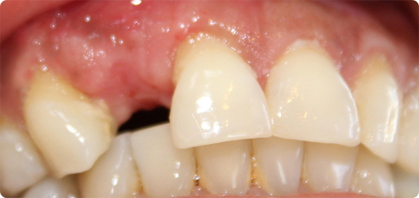 Close-up of gap left by missing tooth