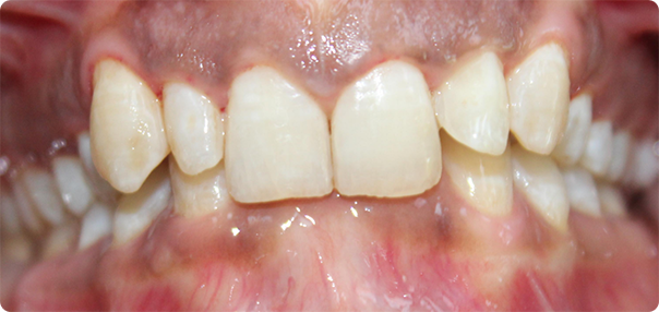 Close-up of uneven teeth