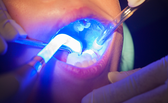 Dental sealants being hardened in place with special light