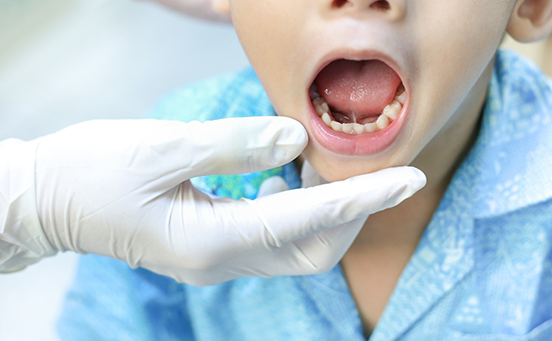 Boy opening mouth to show tongue-tie