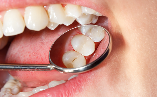 Using dental mirror to examine teeth