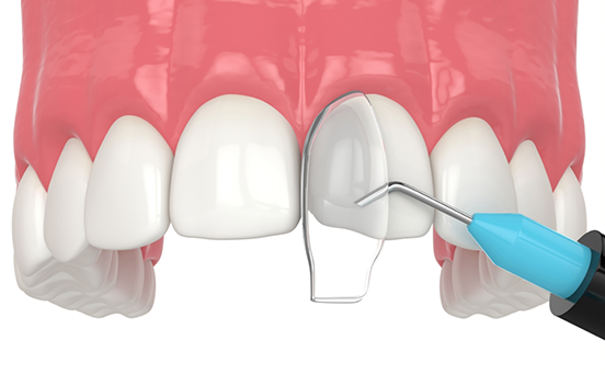 Illustration of cosmetic bonding performed on upper teeth