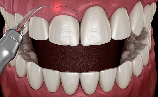 Illustration of gum recontouring performed with laser