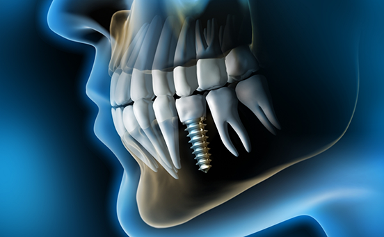 Illustration of dental implant in jawbone