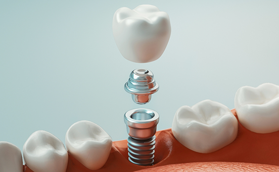 Crown and abutment being attached to dental implant