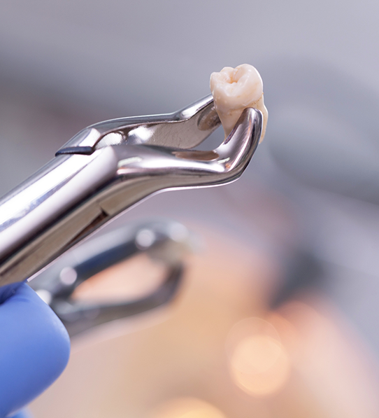 Forceps holding tooth after tooth extraction in Frisco