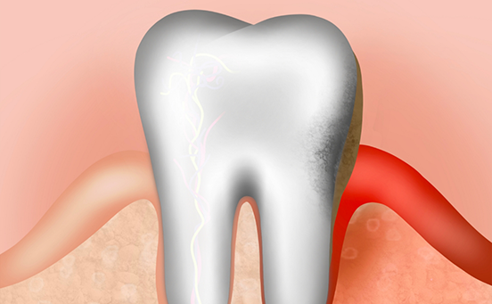 Illustration of tooth and inflamed gums