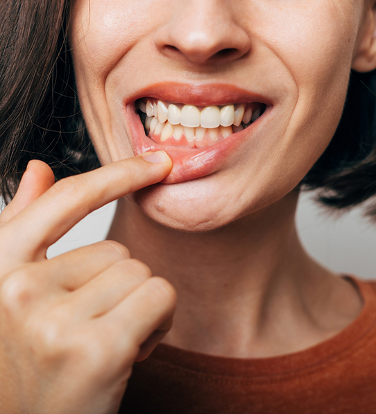 Woman pulling down lip to show gum tissue