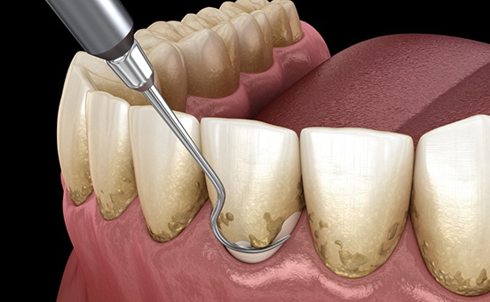 Illustration of scaling and root planing for gum disease treatment in Frisco