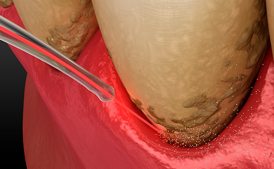 Illustration of laser removing plaque and tartar from teeth and gums