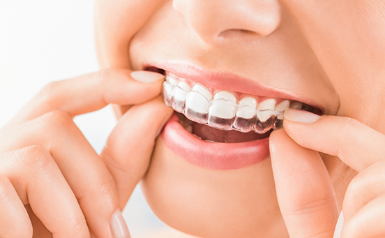 Close-up of clear aligners being placed over teeth