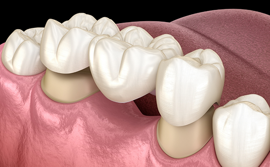 Illustration of dental bridge being placed on teeth