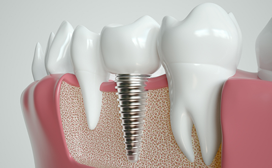 Illustration of dental implant being placed in jaw