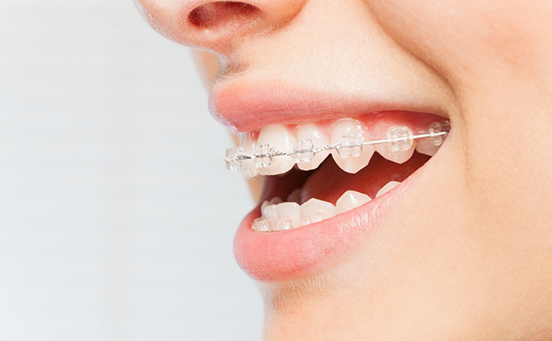 Close up of smile with braces with clear brackets