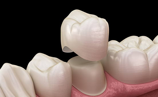 Illustration of dental crown being placed on tooth