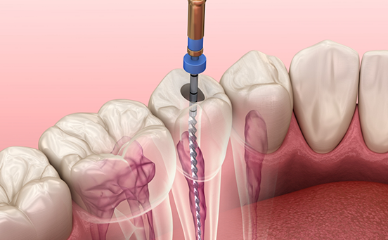 Illustration of root canal treatment for lower tooth